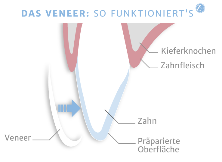 Veneers